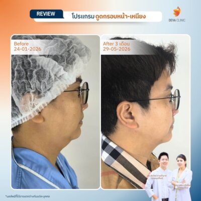 รีวิวหน้า-เหนียง- ดูดไขมัน วังหิน 6