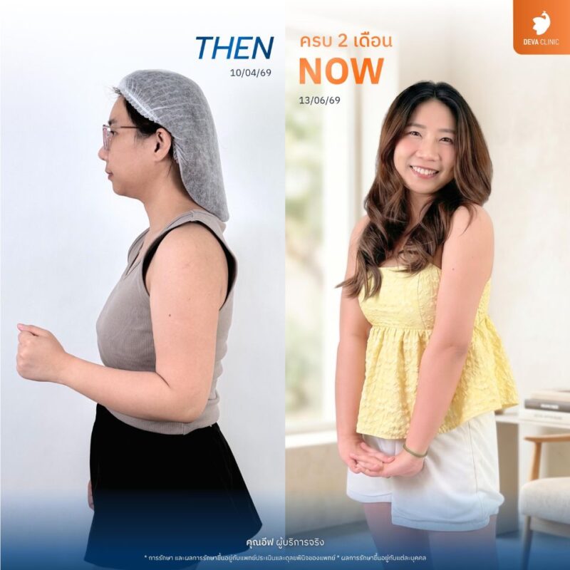 2. ดูดไขมันต้นแขน - ดูดไขมัน รัชดา 2