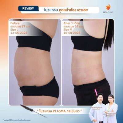 Deva Clinic รีวิวหน้าท้อง 10