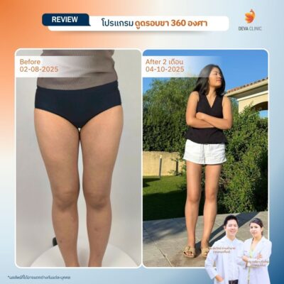 รีวิวดูดขา ดูดไขมัน เกษตรนวมินทร์ 1