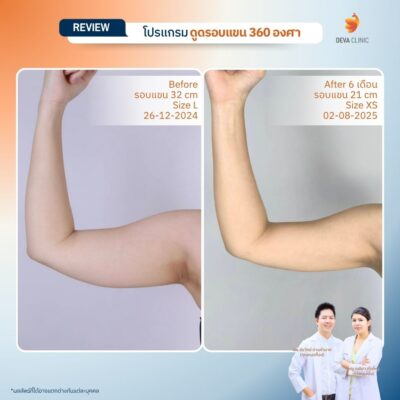 รีวิวต้นแขน - ดูดไขมัน วังหิน 3