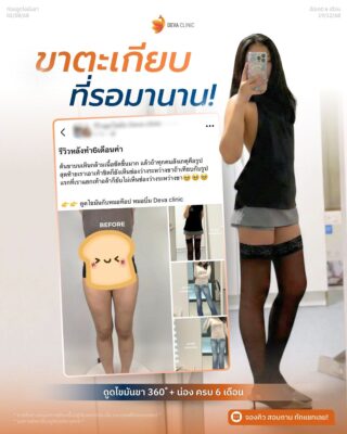 รีวิวดูดไขมันต้นขา 360 องศา รีวิวแชท 03