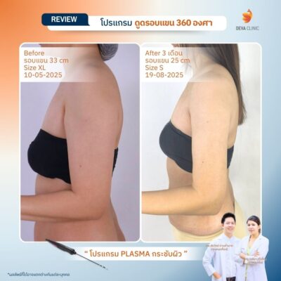 รีวิวต้นแขน - ดูดไขมัน วังหิน 3