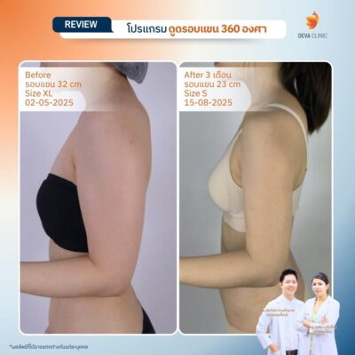 รีวิวดูดแขน ดูดไขมัน เกษตรนวมินทร์ 3