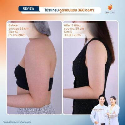 รีวิวดูดแขน ดูดไขมัน เกษตรนวมินทร์ 5