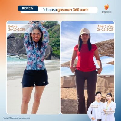 รีวิวต้นขา - ดูดไขมัน วังหิน 16