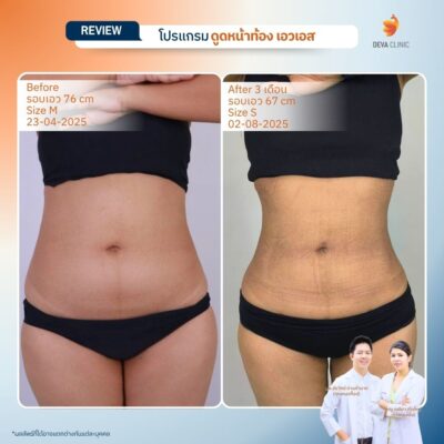 รีวิวดูดหน้าท้อง ดูดไขมัน ลาดพร้าว 71 5