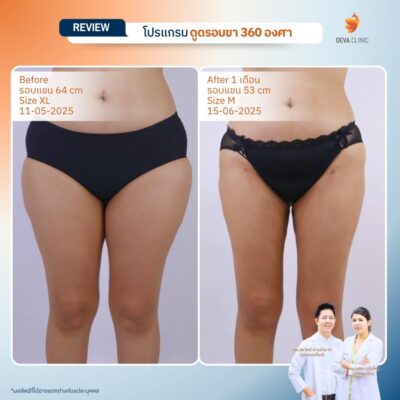 Deva Clinic รีวิวต้นขา 1