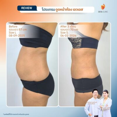 รีวิวดูดหน้าท้อง ดูดไขมัน ลาดพร้าว 71 10