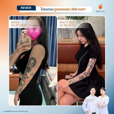 รีวิวดูดไขมันต้นแขน 6