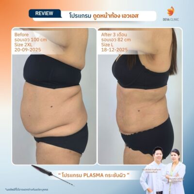 Deva Clinic รีวิวหน้าท้อง 19