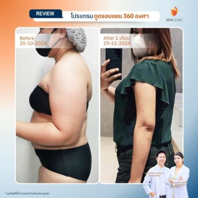 รีวิวดูดต้นแขน ดูดไขมัน ลาดพร้าว 71 6