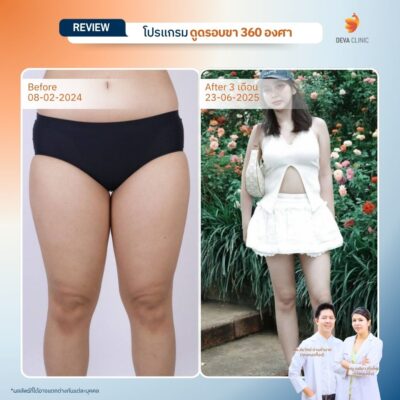 รีวิวต้นขา - ดูดไขมัน วังหิน 13