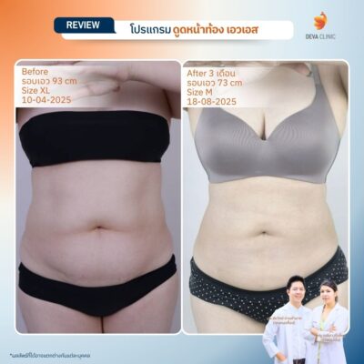 รีวิวดูดไขมันหน้าท้อง 2