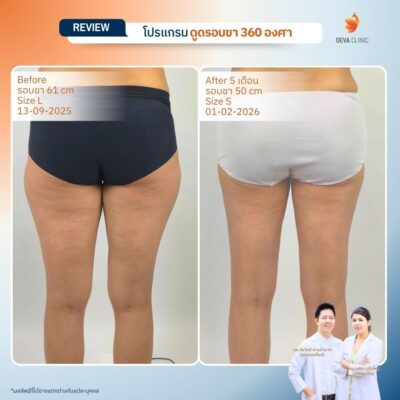 Deva Clinic รีวิวต้นขา 10