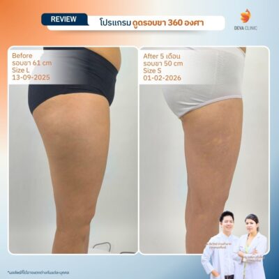 Deva Clinic รีวิวต้นขา 11