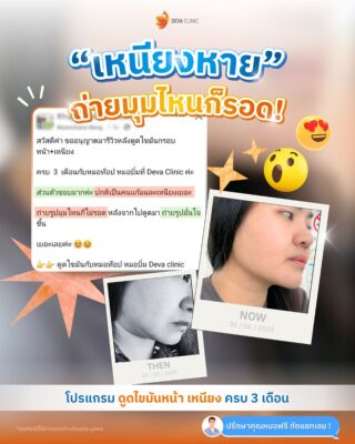 รีวิวดูดไขมันหน้า-เหนียง รีวิวแชท 01