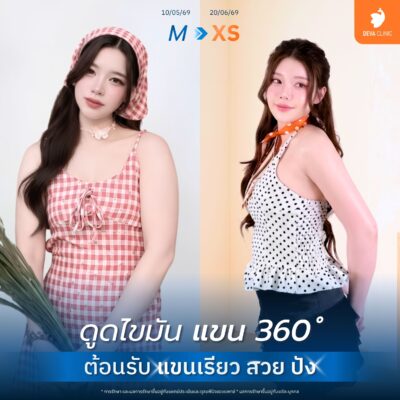 รีวิวดูดไขมันต้นแขน บางกะปิ Deva Clinic 2