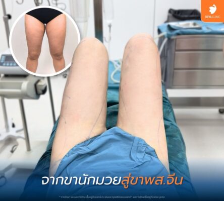 รีวิวดูดไขมันต้นขา 360 องศา ดีว่าคลินิก ดีไหม 02