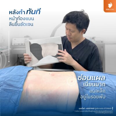 รีวิวดูดไขมันหน้าท้อง เอวเอส ดีว่าคลินิก ดีไหม 04