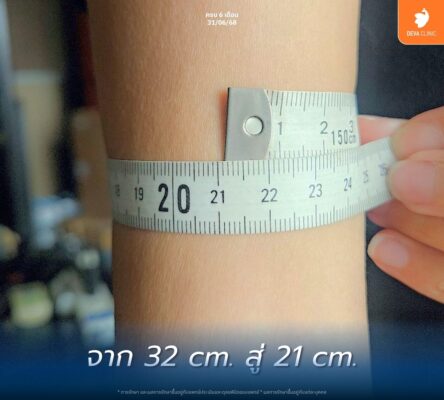 Deva Clinic ดีไหม ประสบการณ์จากผู้ใช้จริง: เปลี่ยนจากไซส์ XL เป็น S 03