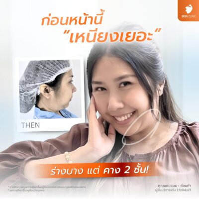 รีวิวดูดไขมันหน้า เหนียง ดีว่าคลินิก ดีไหม 03