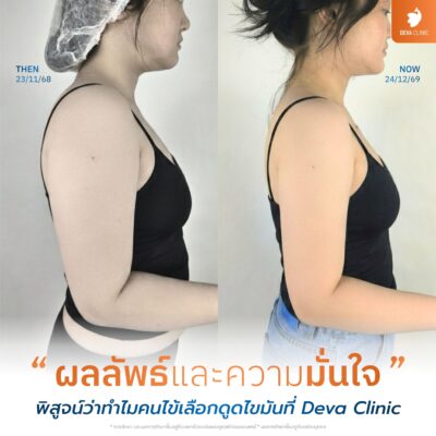 รีวิวดูดไขมันต้นแขน บางกะปิ Deva Clinic 7