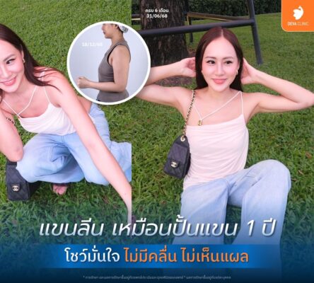 รีวิวดูดไขมันต้นแขน 360 องศา ดีว่าคลินิก ดีไหม 04