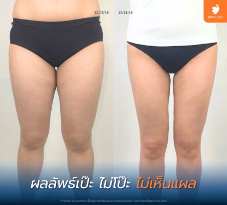 รีวิวดูดไขมันต้นขา 360 องศา ดีว่าคลินิก ดีไหม 04