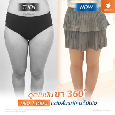 รีวิวดูดไขมันต้นขาบางกะปิ Deva Clinic 5