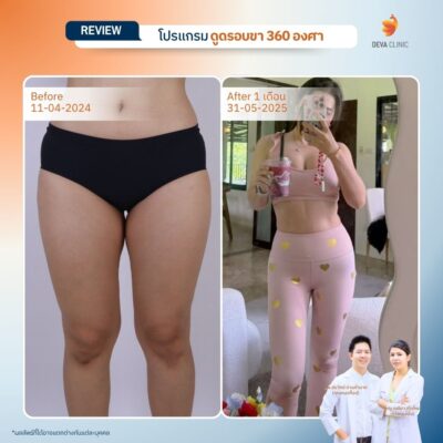 รีวิวดูดขา ดูดไขมัน เกษตรนวมินทร์ 13