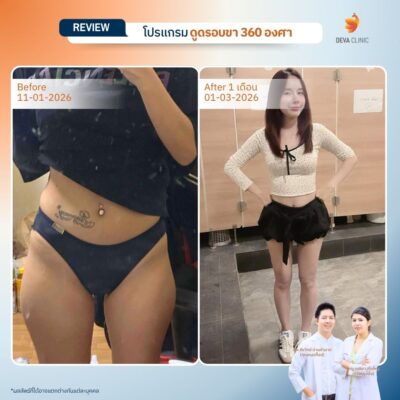 รีวิวดูดขา ดูดไขมัน เกษตรนวมินทร์ 14