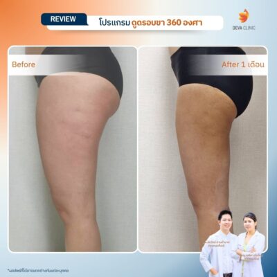 ดีว่าคลินิก รีวิว ลดไซส์กางเกง: จาก XL สู่ S เคสคุณฝน 03