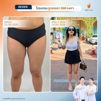รีวิวดูดขา ดูดไขมัน เกษตรนวมินทร์ 15