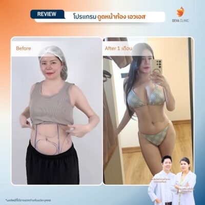 รีวิวหน้าท้อง - ดูดไขมัน วังหิน 7