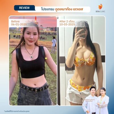 รีวิวดูดไขมันหน้าท้อง 18