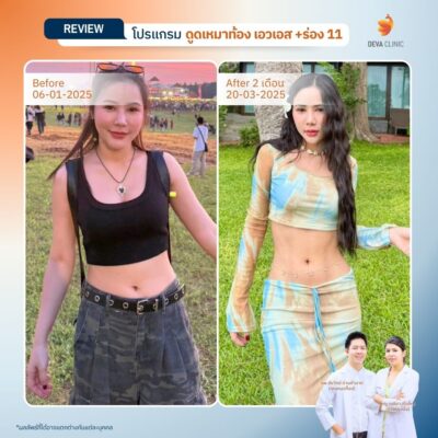 Before & After ดูดหน้าท้อง - ดูดไขมัน นาคนิวาส 5