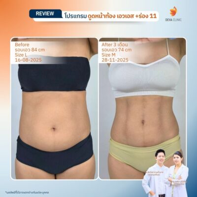 รีวิวดูดไขมันหน้าท้อง 6