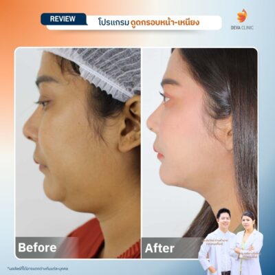 รีวิวดูดหน้า เหนียง 09