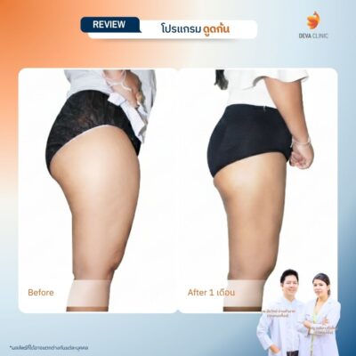 รวมรีวิวเคสดูดไขมันก้น ก่อน-หลัง (Before & After) ที่ Deva Clinic 6