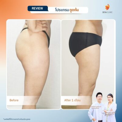 รวมรีวิวเคสดูดไขมันก้น ก่อน-หลัง (Before & After) ที่ Deva Clinic 7
