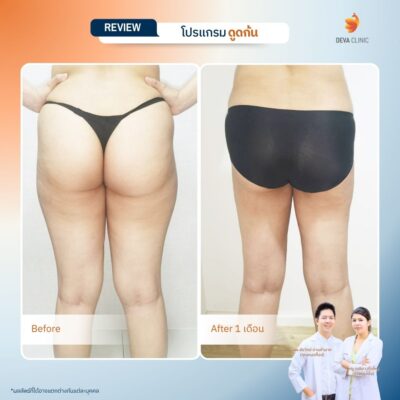 รวมรีวิวเคสดูดไขมันก้น ก่อน-หลัง (Before & After) ที่ Deva Clinic 1