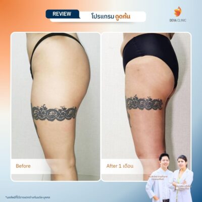 รวมรีวิวเคสดูดไขมันก้น ก่อน-หลัง (Before & After) ที่ Deva Clinic 2