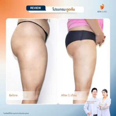 รวมรีวิวเคสดูดไขมันก้น ก่อน-หลัง (Before & After) ที่ Deva Clinic 3