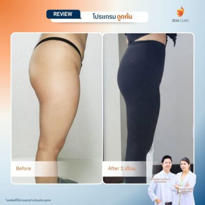 รวมรีวิวเคสดูดไขมันก้น ก่อน-หลัง (Before & After) ที่ Deva Clinic 4