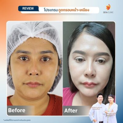 รีวิวดูดหน้า เหนียง 07