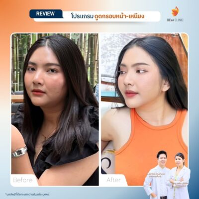 รีวิวดูดหน้า เหนียง 06
