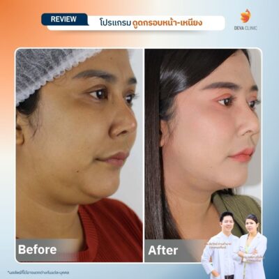 รีวิวดูดหน้า เหนียง 05
