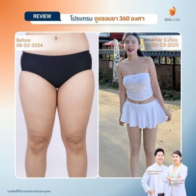 รีวิวลดขาเบียด ดูดไขมันขาใน 11