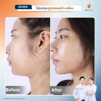 รีวิวผลลัพธ์ ดูดไขมันคาง ราคา 13